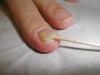 Средства от запущенного грибка ногтей для эффективного лечения Как избавиться от грибка ногтей запущенной формы